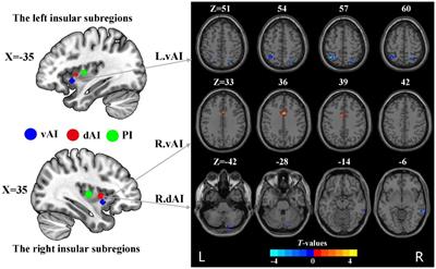 Altered dynamic functional connectivity of insular subdivisions among male cigarette smokers